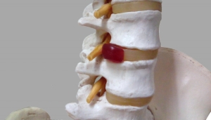 椎間板ヘルニア骨模型